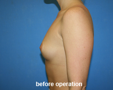 plastic-surgery-breast-augmentation